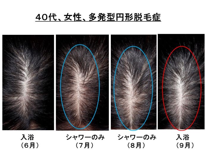 円形脱毛症　病院